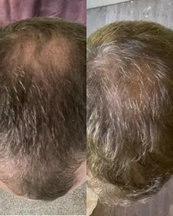 Suero Romero para el crecimiento del cabello Evivor™