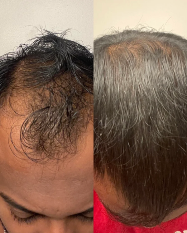 Suero Romero para el crecimiento del cabello Evivor™