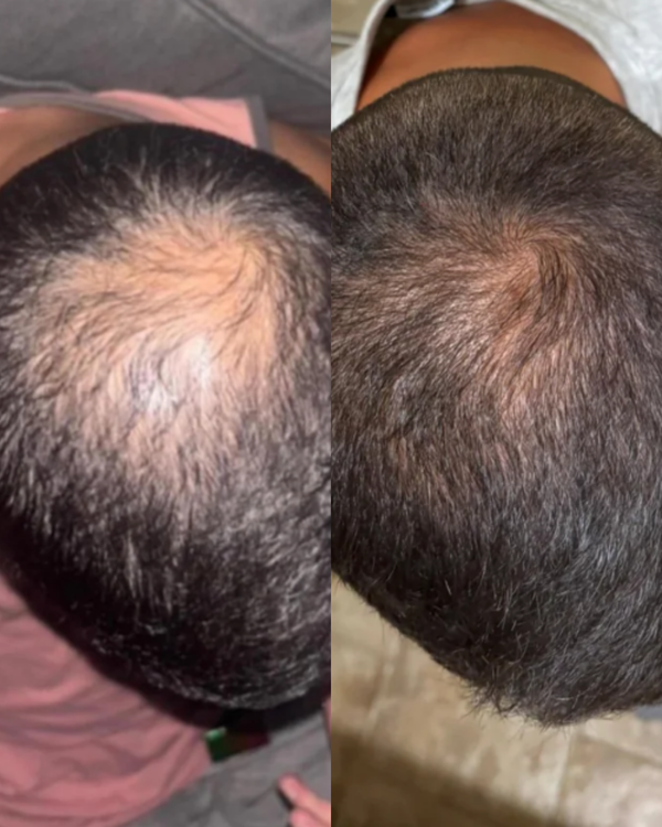 Suero Romero para el crecimiento del cabello Evivor™