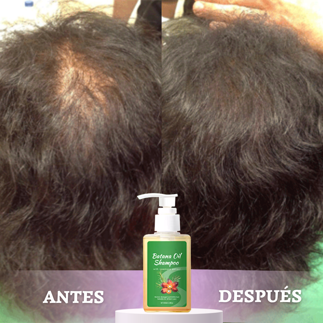 BATANA GOLD™ | DETÉN LA CAÍDA Y REVIVE TU CABELLO DESDE LA RAÍZ EN SOLO 1 SEMANA