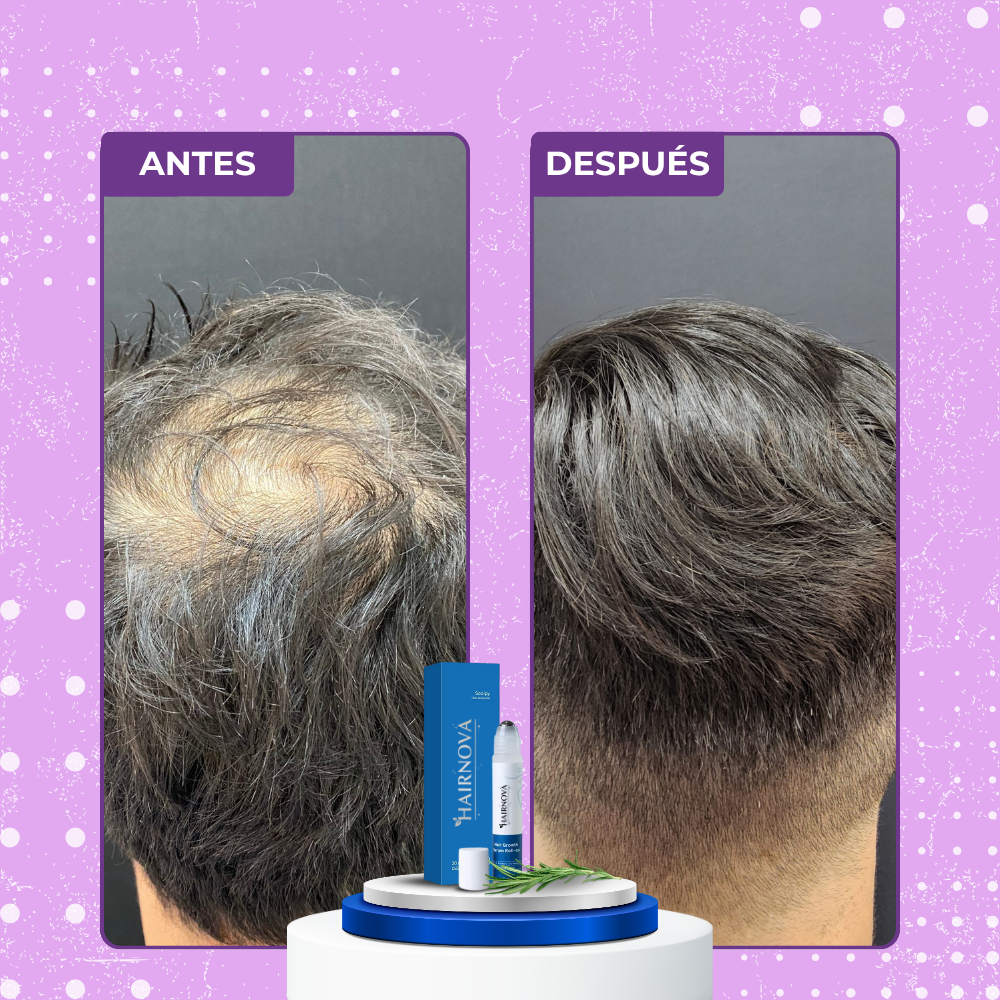 HAIRNOVA™ | Recupera Tu Cabello Perdido en solo una semana