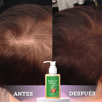 BATANA GOLD™ | DETÉN LA CAÍDA Y REVIVE TU CABELLO DESDE LA RAÍZ EN SOLO 1 SEMANA