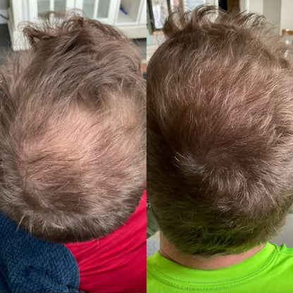 Suero Romero para el crecimiento del cabello Evivor™
