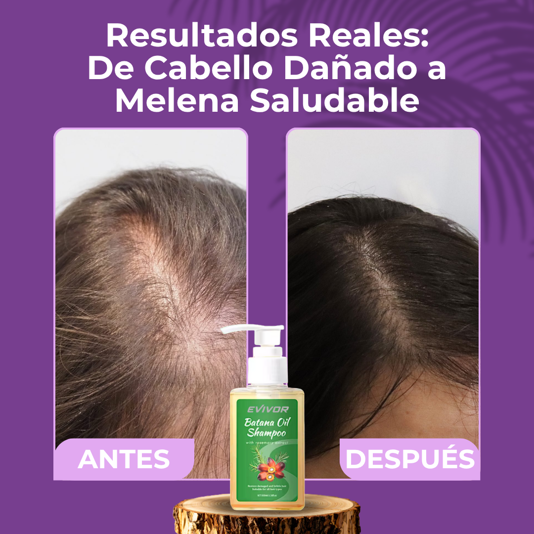 BATANA GOLD™ | DETÉN LA CAÍDA Y REVIVE TU CABELLO DESDE LA RAÍZ EN SOLO 1 SEMANA